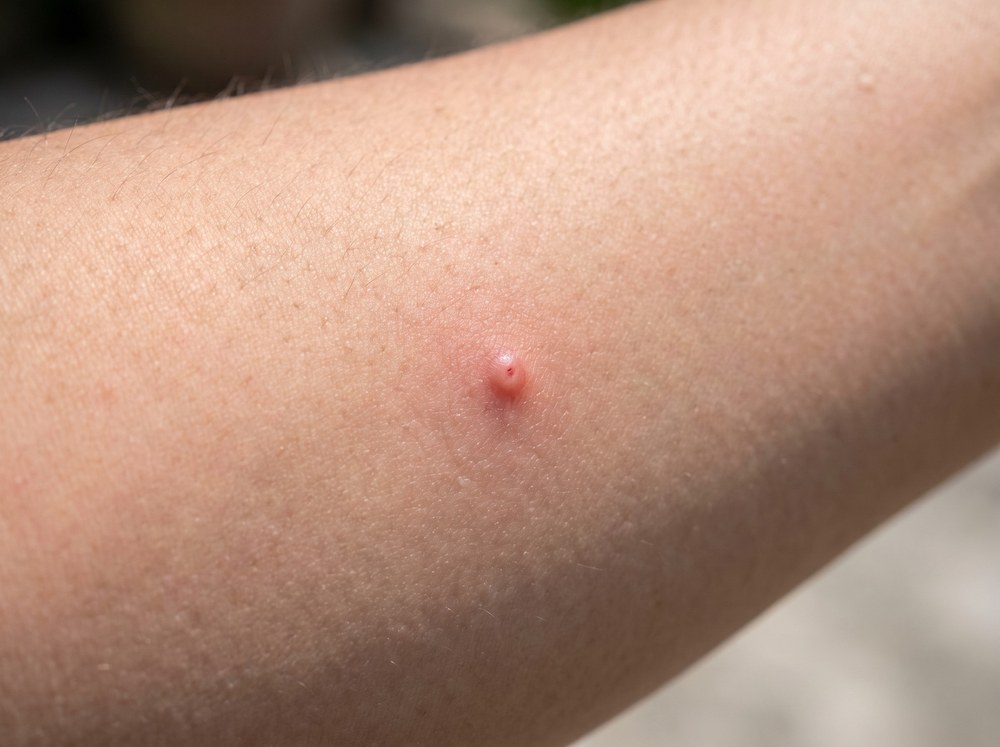 Close-up of a red swollen welt with one small central puncture mark on human skin a few hours after an insect bite