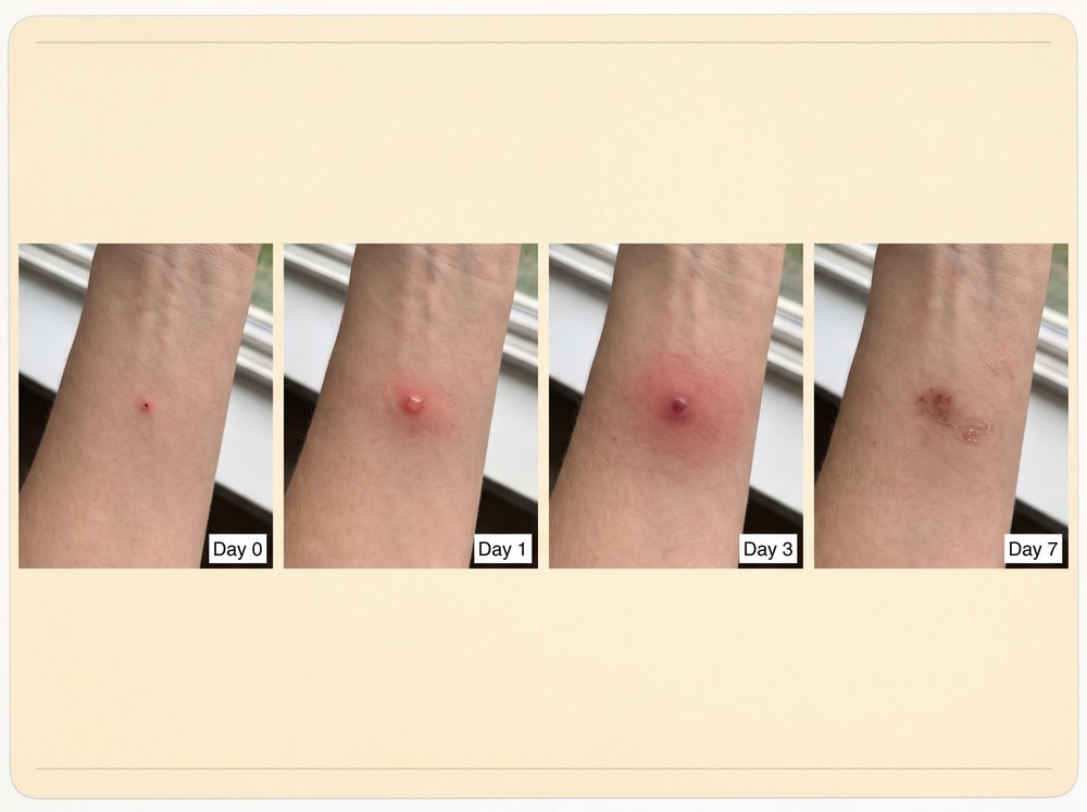 Four panel comparison photo showing a healing insect bite mark on day zero, day one, day three, and day seven